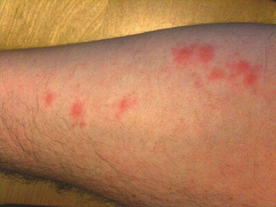 Bed Bug Bites